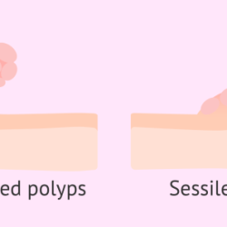 Polyps endometrial types sessile pedunculated uterine