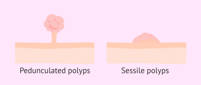 Polyps endometrial types sessile pedunculated uterine